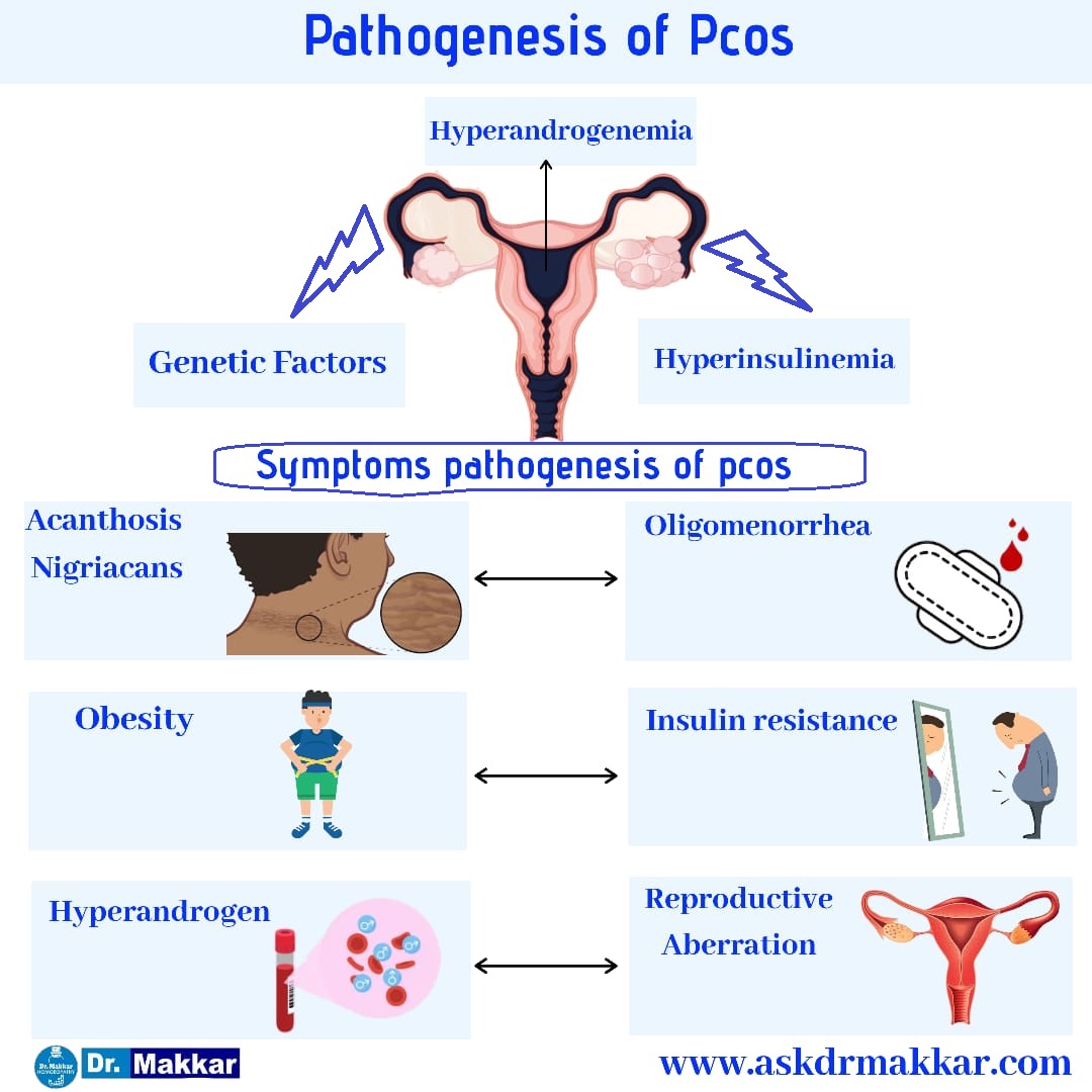 Poly Cystic Ovarian Syndrome PCOS Homeopathic Treatment PCOD Complex poly-cystic-ovarian-syndrome-pcos-homeopathic-treatment-pcod-complex